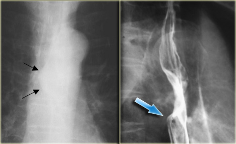 Esophageal leiomyoma