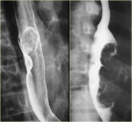 LEFT: Small polypoid carcinoma. RIGHT: Large polypoid lesion.