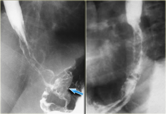 LEFT: Varicoid carcinoma. RIGHT: Superficial spreading carcinoma.