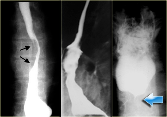 Esophageal obstruction due to metastatic mediastinal lymphnodes.