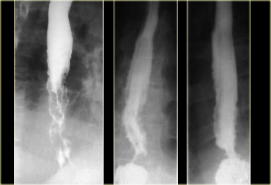 Uphill varices in a patient with cirrhosis.