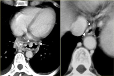 Large mediastinal and esophageal (arrows) varices