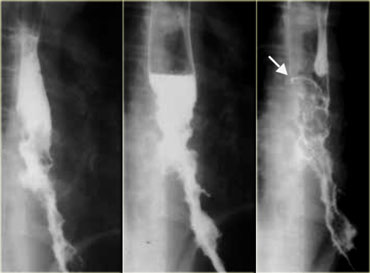 Varicoid carcinoma