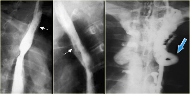 Downhill varices in a patient with a superior vena cava obstruction