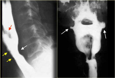 LEFT: Lateral view: Epiglottis (red arrow). Post cricoid impression (yellow arrows). Cricopharyngeous   impression (white arrow).RIGHT: AP-view: Small lateral pharyngeal pouches (arrows)