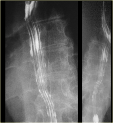 Esophagus mucosa: normal thin, parallel, uniform mucosal folds