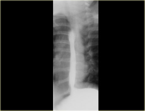 Spontaneous  reflux extends to level of            aortic arch.