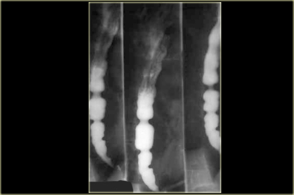 Diffuse esophageal spasm. Patient experienced chest pain during examination