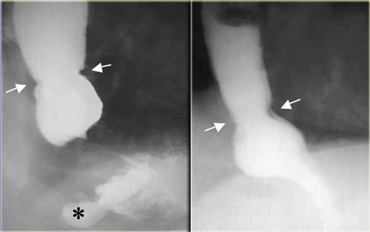 Esophageal ring due to muscular contraction. It varies during examination and may not persist.