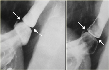 Esophageal B-ring