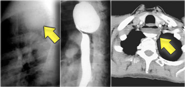 Zenker's diverticulum on chest film, barium study and CT