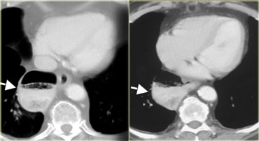 Large epiphrenic diverticulum