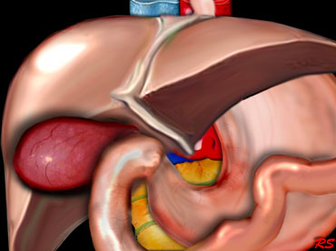 Distended hydropic and hyperemic gallbladder in acute cholecystitis due to stone obstruction in the gallbladder neck or cystic duct.