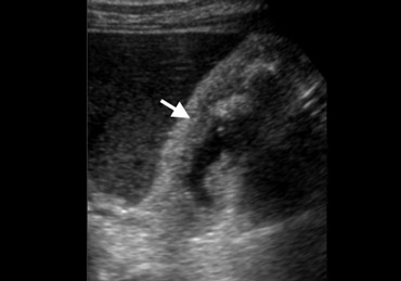 Drug-induced hepatitis with diffuse gallbladder wall thickening