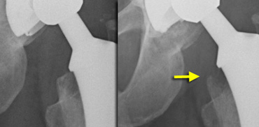 Progressive calcar resorption during folllow up.