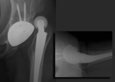 Lateral dislocation of THA