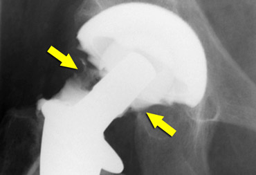 Arthrogram used to confirm intra-articular position of needle in possible infected prosthesis.