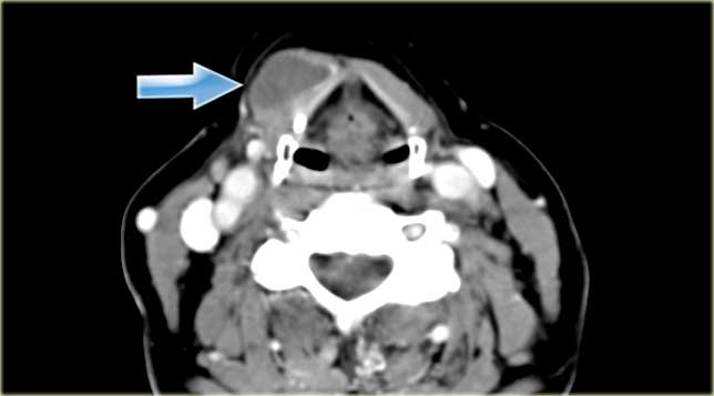 Paramedian thyroglossal duct cyst