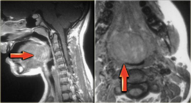 Lingual thyroid (courtesy: Tony Hasso)