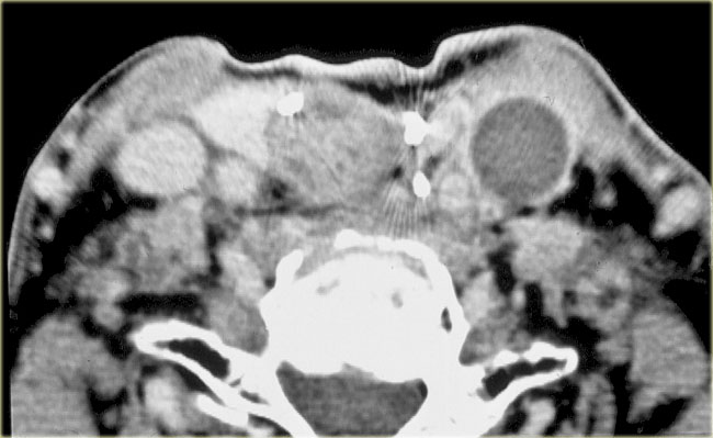 Thrombosis of  jugular vein