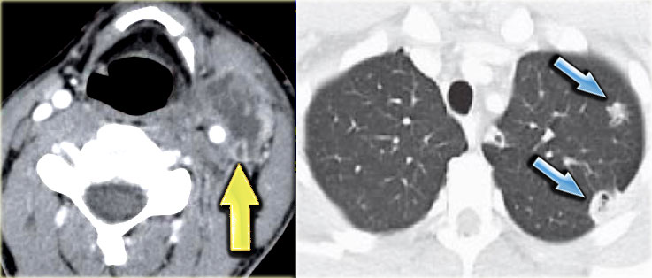 Lemierre' s syndrome