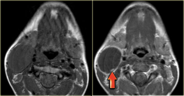 Second branchial cleft cyst