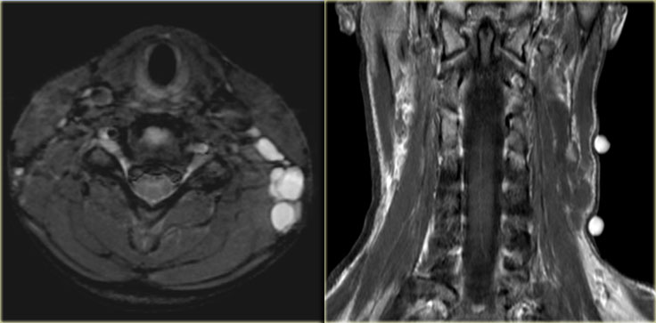 Lymphangioma