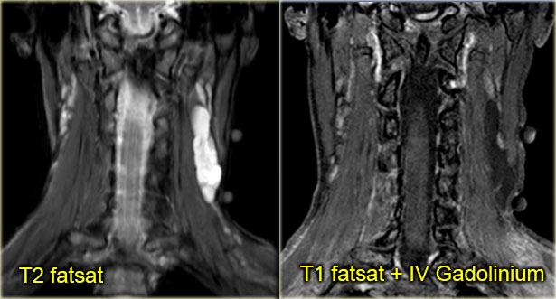 Lymphangioma