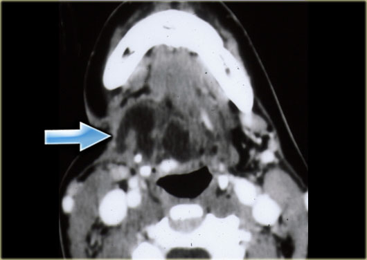 Cystic hygroma located in the right floor of the mouth in a young adult patient (courtesy: Tony Hasso)