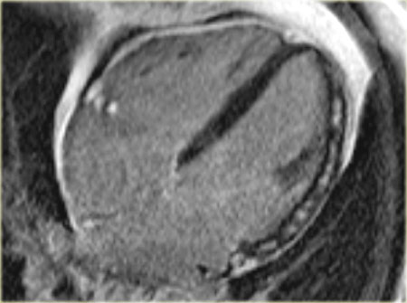 Myocarditis: midmyocardial enhancement