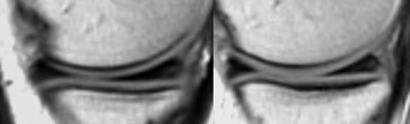 Medial meniscus: The posterior horn is always larger than the anterior horn.