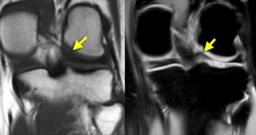 Lateral meniscus: posterior horn and posterior meniscal root.