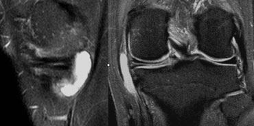 Horizontal tear with a meniscal cyst