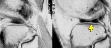 Disrupted bow tie indicating a small radial tear.