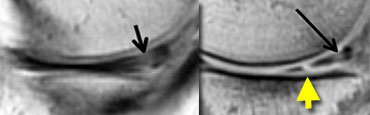 LEFT: Old MR exam with tear. Patient had a suture repair. RIGHT: On new exam, there is a new tear (yellow arrow). It is not possible to tell if the old tear has healed.