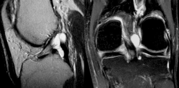 ACL ganglion cyst