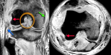 LEFT: cruciate lig.rupture (orange), med coll lig rupture (green), proximal rupture of the fibular collateral ligament (blue).RIGHT: no attachment of popliteus tendon (red arrows)