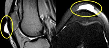 Prepatellar bursitis