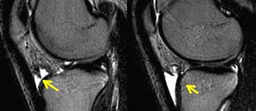 Deep infrapatellar bursitis