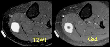 Patient with a palpable mass. Marker is placed. Enhancing lesion due to a neurofibroma.