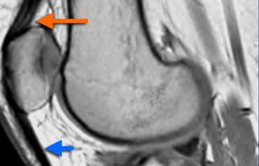 Normal Extensor mechanism: The quadriceps tendon comes in three layers (orange arrow). Patellar tendon (blue arrow) and quadriceps tendon have a sharp posterior demarcation.