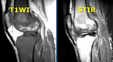 Patient with leukemia and abnormal bone marrow