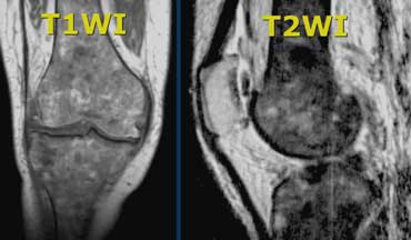 Abnormal bone marrow. There is abnormal signal intensity in the form of circles in metaphysis and epiphysis.