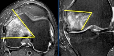 Wedge-shaped bone infarction in AVN