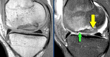 Unstable Osteochondritis Dissecans. The only helpfull sign for the diagnosis unstable OD is the fluid (yellow arrow) not the edema nor the break in the osteochondral surface (green arrow).