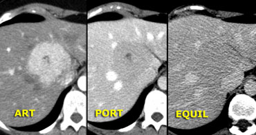 'Capillary blush' in FNH. Notice early enhancement, but not as bright as in hemangioma. In venous and delayed phase the enhancement is almost isodense to the liver.