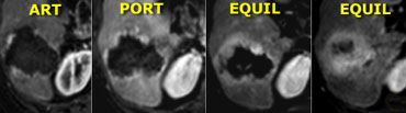 Typical hemangioma on dynamic MR