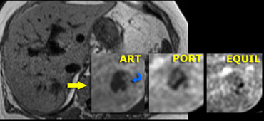 MR depicts enhancement better than CT