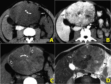 Left-lobe fibrolamellar HCC. Courtesy Dr. Federle and Dr. Ichikawa (3)