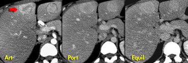 Adenomas in arterial, portal venous and equilibrium phase